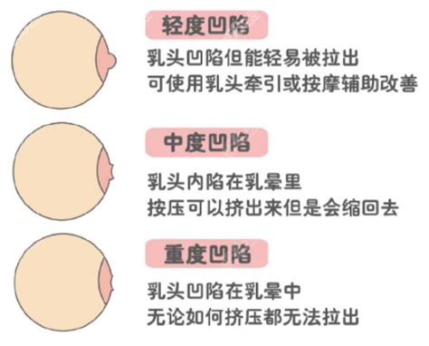 女人的乳頭|乳頭內凹、長毛正常嗎？ 8類「乳頭形狀」你的是哪種